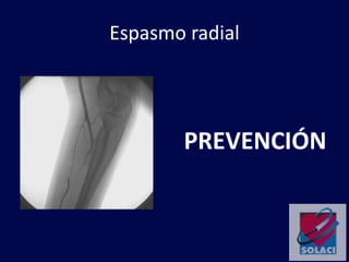 Espasmo radial
PREVENCIÓN
 