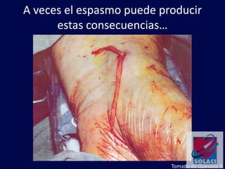 A veces el espasmo puede producir
estas consecuencias…
Tomado de Quesada R
 