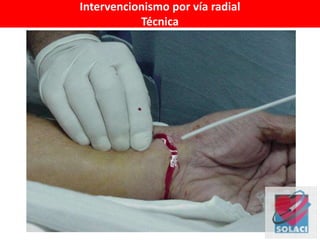 Intervencionismo por vía radial
Técnica
 