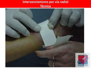 Intervencionismo por vía radial
Técnica
 