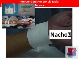 Intervencionismo por vía radial
Técnica
Nachoᴿ
 