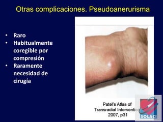 Otras complicaciones. Pseudoanerurisma
• Raro
• Habitualmente
coregible por
compresión
• Raramente
necesidad de
cirugía
 
