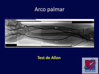 Arco palmar
Test de Allen
 