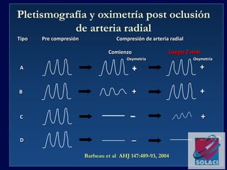 Tipo Pre compresión Compresión de arteria radial
Comienzo Luego 2 min.
+AA +
+B +
+C
_
_D _
Oxymetría Oxymetría
Pletismografía y oximetría post oclusión
de arteria radial
Barbeau et al AHJ 147:489-93, 2004
1.5%
 