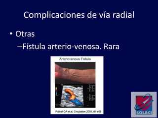 Complicaciones de vía radial
• Otras
–Fístula arterio-venosa. Rara
 