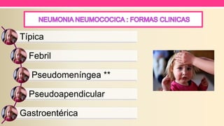 Típica
Febril
Pseudomeníngea **
Pseudoapendicular
Gastroentérica
 