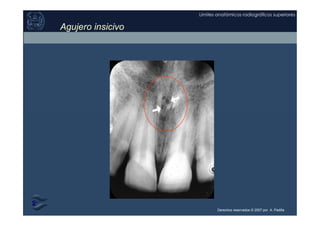 Derechos reservados © 2007 por A. Padilla
Límites anatómicos radiográficos superiores
Agujero insicivo
 