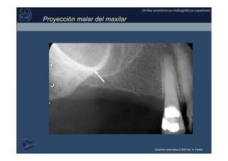 Derechos reservados © 2007 por A. Padilla
Límites anatómicos radiográficos superiores
Proyección malar del maxilar
 