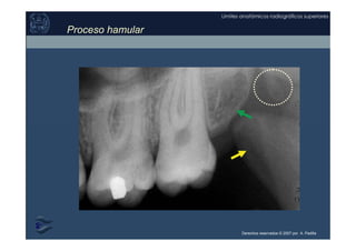 Derechos reservados © 2007 por A. Padilla
Límites anatómicos radiográficos superiores
Proceso hamular
 