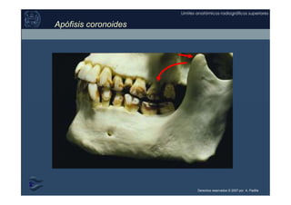 Derechos reservados © 2007 por A. Padilla
Límites anatómicos radiográficos superiores
Apófisis coronoides
 