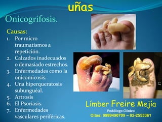 Onicogrifosis.
Causas:
1. Por micro
traumatismos a
repetición.
2. Calzados inadecuados
o demasiado estrechos.
3. Enfermedades como la
onicomicosis.
4. Una hiperqueratosis
subunguéal.
5. Artrosis
6. El Psoriasis.
7. Enfermedades
vasculares periféricas.

Límber Freire Mejía
Podólogo Clínico

Citas: 0999490709 – 02-2553361

 