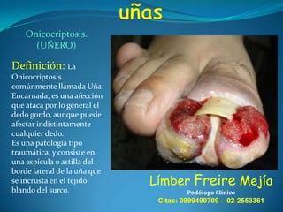 Onicocriptosis.
(UÑERO)

Definición: La
Onicocriptosis
comúnmente llamada Uña
Encarnada, es una afección
que ataca por lo general el
dedo gordo, aunque puede
afectar indistintamente
cualquier dedo.
Es una patología tipo
traumática, y consiste en
una espícula o astilla del
borde lateral de la uña que
se incrusta en el tejido
blando del surco.

Límber Freire Mejía
Podólogo Clínico

Citas: 0999490709 – 02-2553361

 