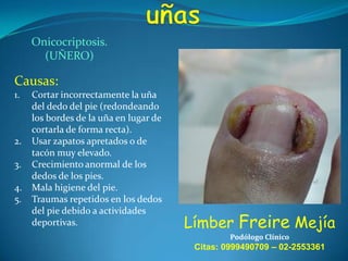 Onicocriptosis.
(UÑERO)

Causas:
1.

2.

3.
4.
5.

Cortar incorrectamente la uña
del dedo del pie (redondeando
los bordes de la uña en lugar de
cortarla de forma recta).
Usar zapatos apretados o de
tacón muy elevado.
Crecimiento anormal de los
dedos de los pies.
Mala higiene del pie.
Traumas repetidos en los dedos
del pie debido a actividades
deportivas.

Límber Freire Mejía
Podólogo Clínico

Citas: 0999490709 – 02-2553361

 
