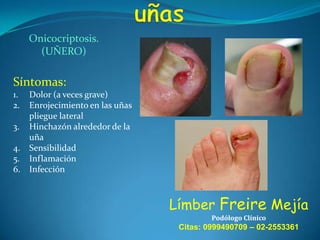 Onicocriptosis.
(UÑERO)

Síntomas:
1.
2.
3.

4.
5.
6.

Dolor (a veces grave)
Enrojecimiento en las uñas
pliegue lateral
Hinchazón alrededor de la
uña
Sensibilidad
Inflamación
Infección

Límber Freire Mejía
Podólogo Clínico

Citas: 0999490709 – 02-2553361

 