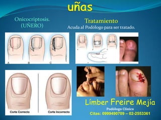 Onicocriptosis.
(UÑERO)

Tratamiento
Acuda al Podólogo para ser tratado.

Límber Freire Mejía
Podólogo Clínico

Citas: 0999490709 – 02-2553361

 