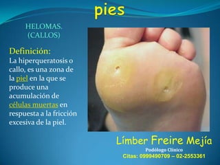 HELOMAS.
(CALLOS)

Definición:
La hiperqueratosis o
callo, es una zona de
la piel en la que se
produce una
acumulación de
células muertas en
respuesta a la fricción
excesiva de la piel.

Límber Freire Mejía
Podólogo Clínico

Citas: 0999490709 – 02-2553361

 