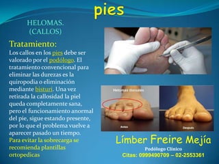 HELOMAS.
(CALLOS)

Tratamiento:
Los callos en los pies debe ser
valorado por el podólogo. El
tratamiento convencional para
eliminar las durezas es la
quiropodia o eliminación
mediante bisturí. Una vez
retirada la callosidad la piel
queda completamente sana,
pero el funcionamiento anormal
del pie, sigue estando presente,
por lo que el problema vuelve a
aparecer pasado un tiempo.
Para evitar la sobrecarga se
recomienda plantillas
ortopedicas

Límber Freire Mejía
Podólogo Clínico

Citas: 0999490709 – 02-2553361

 