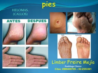 HELOMAS.
(CALLOS)

Límber Freire Mejía
Podólogo Clínico

Citas: 0999490709 – 02-2553361

 