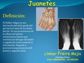 Definición:
El Hallux Valgus es una
desviación del dedo gordo del
pie hacia el resto de los dedos
del pie. Es una prominencia de
la cabeza del primer
metatarsiano (hueso que
continúa las falanges del dedo)
y angulación inadecuada de la
articulación, llegando a
provocar la superposición del
primer y segundo dedo.

Límber Freire Mejía
Podólogo Clínico

Citas: 0999490709 – 02-2553361

 