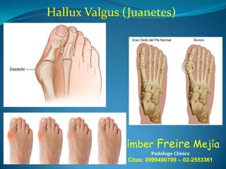 Hallux Valgus (Juanetes)

Límber Freire Mejía
Podólogo Clínico

Citas: 0999490709 – 02-2553361

 