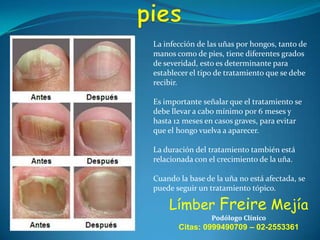 La infección de las uñas por hongos, tanto de
manos como de pies, tiene diferentes grados
de severidad, esto es determinante para
establecer el tipo de tratamiento que se debe
recibir.

Es importante señalar que el tratamiento se
debe llevar a cabo mínimo por 6 meses y
hasta 12 meses en casos graves, para evitar
que el hongo vuelva a aparecer.
La duración del tratamiento también está
relacionada con el crecimiento de la uña.
Cuando la base de la uña no está afectada, se
puede seguir un tratamiento tópico.

Límber Freire Mejía
Podólogo Clínico

Citas: 0999490709 – 02-2553361

 