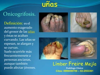 Onicogrifosis.
Definición: es el
aumento exagerado
del grosor de las uñas
y éstas se acaban
curvando. Las uñas se
espesan, se alargan y
se curvan.
Suele ocurrirle más
frecuentemenete a
personas ancianas,
aunque también
puede afectar jóvenes.

Límber Freire Mejía
Podólogo Clínico

Citas: 0999490709 – 02-2553361

 