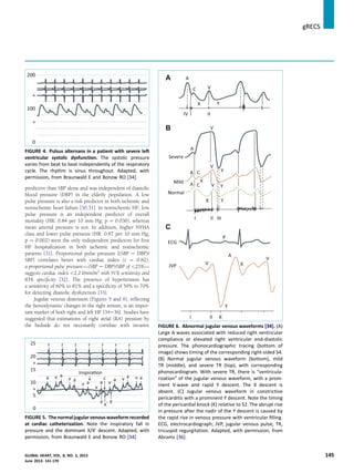 predictive than SBP alone and was independent of diastolic
blood pressure (DBP) in the elderly population. A low
pulse pressure is also a risk predictor in both ischemic and
nonischemic heart failure [30,31]. In nonischemic HF, low
pulse pressure is an independent predictor of overall
mortality (HR: 0.84 per 10 mm Hg; p ¼ 0.036), whereas
mean arterial pressure is not. In addition, higher NYHA
class and lower pulse pressure (HR: 0.87 per 10 mm Hg;
p ¼ 0.002) were the only independent predictors for ﬁrst
HF hospitalization in both ischemic and nonischemic
patients [31]. Proportional pulse pressure [(SBP e DBP)/
SBP] correlates better with cardiac index (r ¼ 0.82);
a proportional pulse pressure—(SBP e DBP)/SBP of <25%—
suggests cardiac index <2.2 l/min/m2
with 91% sensitivity and
83% speciﬁcity [32]. The presence of hypertension has
a sensitivity of 60% to 81% and a speciﬁcity of 59% to 70%
for detecting diastolic dysfunction [33].
Jugular venous distension (Figures 5 and 6), reﬂecting
the hemodynamic changes in the right atrium, is an impor-
tant marker of both right and left HF [34e36]. Studies have
suggested that estimations of right atrial (RA) pressure by
the bedside do not necessarily correlate with invasive
A
B
C
FIGURE 6. Abnormal jugular venous waveforms [34]. (A)
Large A waves associated with reduced right ventricular
compliance or elevated right ventricular end-diastolic
pressure. The phonocardiographic tracing (bottom of
image) shows timing of the corresponding right-sided S4.
(B) Normal jugular venous waveform (bottom), mild
TR (middle), and severe TR (top), with corresponding
phonocardiogram. With severe TR, there is “ventricula-
rization” of the jugular venous waveform, with a prom-
inent V-wave and rapid Y descent. The X descent is
absent. (C) Jugular venous waveform in constrictive
pericarditis with a prominent Y descent. Note the timing
of the pericardial knock (K) relative to S2. The abrupt rise
in pressure after the nadir of the Y descent is caused by
the rapid rise in venous pressure with ventricular ﬁlling.
ECG, electrocardiograph; JVP, jugular venous pulse; TR,
tricuspid regurgitation. Adapted, with permission, from
Abrams [36].
FIGURE 4. Pulsus alternans in a patient with severe left
ventricular systolic dysfunction. The systolic pressure
varies from beat to beat independently of the respiratory
cycle. The rhythm is sinus throughout. Adapted, with
permission, from Braunwald E and Bonow RO [34].
FIGURE 5. Thenormaljugularvenous waveform recorded
at cardiac catheterization. Note the inspiratory fall in
pressure and the dominant X/X0
descent. Adapted, with
permission, from Braunwald E and Bonow RO [34].
gRECS j
GLOBAL HEART, VOL. 8, NO. 2, 2013 145
June 2013: 141-170
 