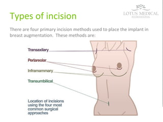 Types of incision
There are four primary incision methods used to place the implant in
breast augmentation. These methods are:
 