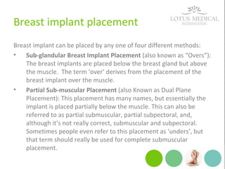 Breast implant placement
Breast implant can be placed by any one of four different methods:
• Sub-glandular Breast Implant Placement (also known as “Overs”):
The breast implants are placed below the breast gland but above
the muscle. The term ‘over’ derives from the placement of the
breast implant over the muscle.
• Partial Sub-muscular Placement (also Known as Dual Plane
Placement): This placement has many names, but essentially the
implant is placed partially below the muscle. This can also be
referred to as partial submuscular, partial subpectoral, and,
although it’s not really correct, submuscular and subpectoral.
Sometimes people even refer to this placement as ‘unders’, but
that term should really be used for complete submuscular
placement.
 