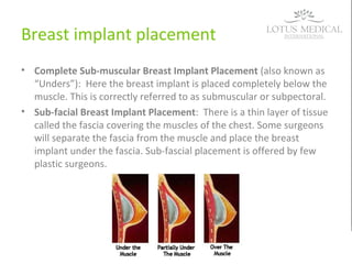 Breast implant placement
• Complete Sub-muscular Breast Implant Placement (also known as
“Unders”): Here the breast implant is placed completely below the
muscle. This is correctly referred to as submuscular or subpectoral.
• Sub-facial Breast Implant Placement: There is a thin layer of tissue
called the fascia covering the muscles of the chest. Some surgeons
will separate the fascia from the muscle and place the breast
implant under the fascia. Sub-fascial placement is offered by few
plastic surgeons.
 