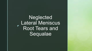 z
Neglected
Lateral Meniscus
Root Tears and
Sequalae
 