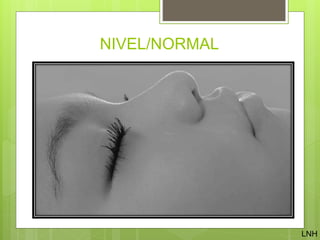NIVEL/NORMAL
LNH
 