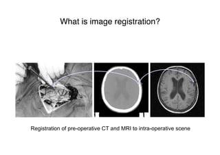 What is image registration?
Registration of pre-operative CT and MRI to intra-operative scene
 