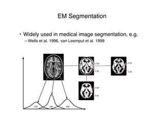• Widely used in medical image segmentation, e.g.
– Wells et al. 1996, van Leemput et al. 1999
0.95
0.05
0.95
0.95
0.95 0.05
WMGMCSF
EM Segmentation
 
