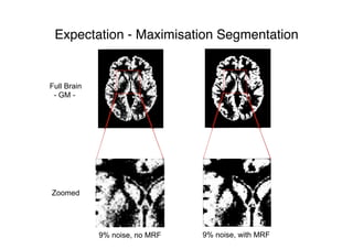 Full Brain
- GM -
Zoomed
9% noise, no MRF
Expectation - Maximisation Segmentation
9% noise, with MRF
 
