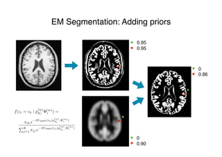 EM Segmentation: Adding priors
0.95
0.95
0
0.90
0
0.86
m) (m)
z ) =
⇡ik e
UMRF(ek|p
(m)
Ni
, (m)
z )
PK
j=1 ⇡ij e
UMRF(ej |p
(m)
Ni
,
(m)
z )
f(zi = ek | p
(m)
Ni
(m)
z ) =
⇡ik e
UMRF(ek|p
(m)
Ni
, (m)
z )
PK
j=1 ⇡ij e
UMRF(ej |p
(m)
Ni
,
(m)
z )
 