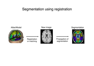 Segmentation using registration
Atlas/Model Segmentation
Registration
or matching
New image
Propagation of
segmentation
 