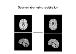 Segmentation using registration
 