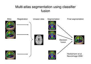 Multi-atlas segmentation using classiﬁer
fusion
Atlas SegmentationRegistration Unseen data
Decision
fusion
Final segmentation
Heckemann et al.
Neuroimage 2006
 