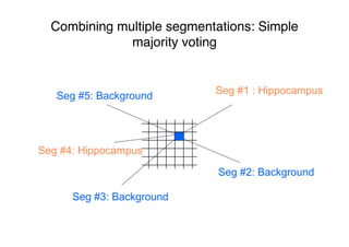 Seg #3: Background
Seg #1 : Hippocampus
Seg #2: Background
Seg #4: Hippocampus
Seg #5: Background
Combining multiple segmentations: Simple
majority voting
 