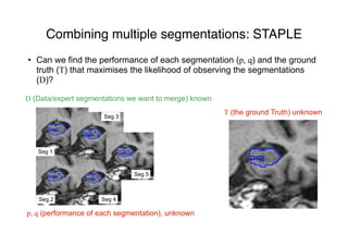 Combining multiple segmentations: STAPLE
• Can we find the performance of each segmentation (p, q) and the ground
truth (T) that maximises the likelihood of observing the segmentations
(D)?
D (Data/expert segmentations we want to merge) known
T (the ground Truth) unknown
Seg 1
Seg 2
Seg 3
Seg 4
Seg 5
p, q (performance of each segmentation), unknown
 