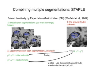 Solved iteratively by Expectation-Maximization (EM) (Warfield et al., 2004)
D (Data/expert segmentations you want to merge)
known
p, q (performance of each segmentation), unknown
T (the ground Truth)
unknown
p(0), q(0) : initial estimate
f (T | D, p(0), q(0))
E-step
p(1), q(1) : next estimate
M-step : use the current ground truth
to estimate the next p(1), q(1).
Combining multiple segmentations: STAPLE
 