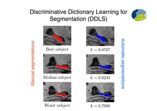 Discriminative Dictionary Learning for
Segmentation (DDLS)
Manualsegmentations
Automaticsegmentations
 