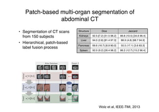 Patch-based multi-organ segmentation of
abdominal CT
• Segmentation of CT scans
from 150 subjects
• Hierarchical, patch-based
label fusion process
Structure Dice Jaccard
Kidneys 92.5 (7.2) [51.5 98.2] 86.8 (10.5) [34.6 96.4]
Liver 94.0 (2.8) [81.4 97.3] 88.9 (4.8) [68.7 94.9]
Pancreas 69.6 (16.7) [6.9 90.0] 55.5 (17.1) [3.6 83.3]
Spleen 92.0 (9.2) [26.4 98.2] 86.2 (12.7) [15.2 96.4]
Wolz et al, MICCAI, 2013Wolz et al, IEEE-TMI, 2013
 