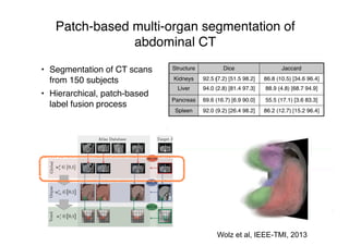 Patch-based multi-organ segmentation of
abdominal CT
• Segmentation of CT scans
from 150 subjects
• Hierarchical, patch-based
label fusion process
Structure Dice Jaccard
Kidneys 92.5 (7.2) [51.5 98.2] 86.8 (10.5) [34.6 96.4]
Liver 94.0 (2.8) [81.4 97.3] 88.9 (4.8) [68.7 94.9]
Pancreas 69.6 (16.7) [6.9 90.0] 55.5 (17.1) [3.6 83.3]
Spleen 92.0 (9.2) [26.4 98.2] 86.2 (12.7) [15.2 96.4]
Wolz et al, MICCAI, 2013Wolz et al, IEEE-TMI, 2013
 