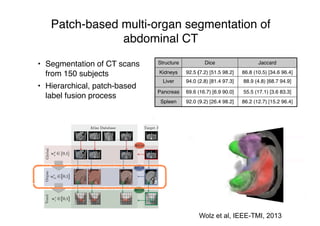 Patch-based multi-organ segmentation of
abdominal CT
• Segmentation of CT scans
from 150 subjects
• Hierarchical, patch-based
label fusion process
Structure Dice Jaccard
Kidneys 92.5 (7.2) [51.5 98.2] 86.8 (10.5) [34.6 96.4]
Liver 94.0 (2.8) [81.4 97.3] 88.9 (4.8) [68.7 94.9]
Pancreas 69.6 (16.7) [6.9 90.0] 55.5 (17.1) [3.6 83.3]
Spleen 92.0 (9.2) [26.4 98.2] 86.2 (12.7) [15.2 96.4]
Wolz et al, IEEE-TMI, 2013
 