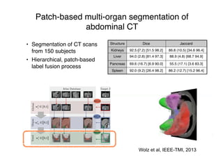 Patch-based multi-organ segmentation of
abdominal CT
• Segmentation of CT scans
from 150 subjects
• Hierarchical, patch-based
label fusion process
Structure Dice Jaccard
Kidneys 92.5 (7.2) [51.5 98.2] 86.8 (10.5) [34.6 96.4]
Liver 94.0 (2.8) [81.4 97.3] 88.9 (4.8) [68.7 94.9]
Pancreas 69.6 (16.7) [6.9 90.0] 55.5 (17.1) [3.6 83.3]
Spleen 92.0 (9.2) [26.4 98.2] 86.2 (12.7) [15.2 96.4]
Wolz et al, IEEE-TMI, 2013
 