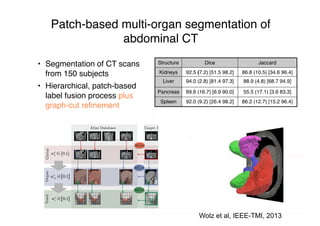 Patch-based multi-organ segmentation of
abdominal CT
• Segmentation of CT scans
from 150 subjects
• Hierarchical, patch-based
label fusion process plus
graph-cut reﬁnement
Structure Dice Jaccard
Kidneys 92.5 (7.2) [51.5 98.2] 86.8 (10.5) [34.6 96.4]
Liver 94.0 (2.8) [81.4 97.3] 88.9 (4.8) [68.7 94.9]
Pancreas 69.6 (16.7) [6.9 90.0] 55.5 (17.1) [3.6 83.3]
Spleen 92.0 (9.2) [26.4 98.2] 86.2 (12.7) [15.2 96.4]
Wolz et al, IEEE-TMI, 2013
 