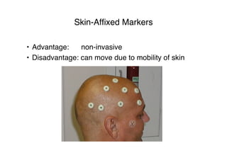 Skin-Afﬁxed Markers
• Advantage: non-invasive
• Disadvantage: can move due to mobility of skin
 