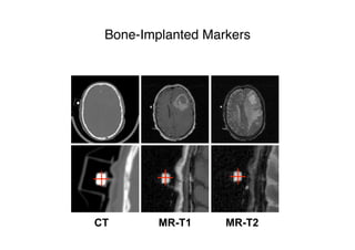 Bone-Implanted Markers
CT MR-T1 MR-T2
 